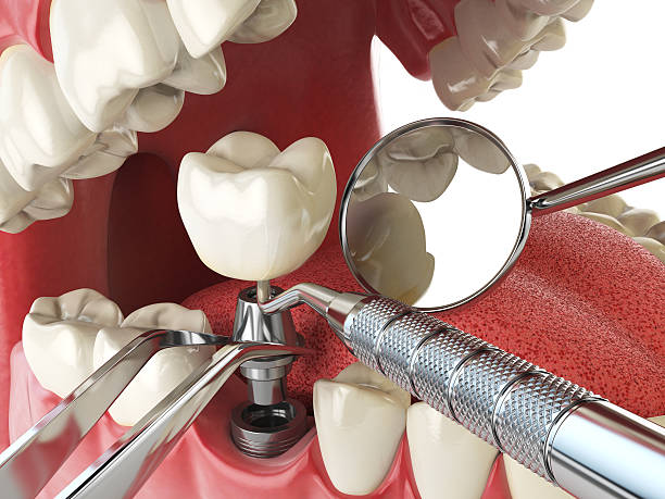 Best Chipped Tooth Repair Near Me  in Carlyss, LA